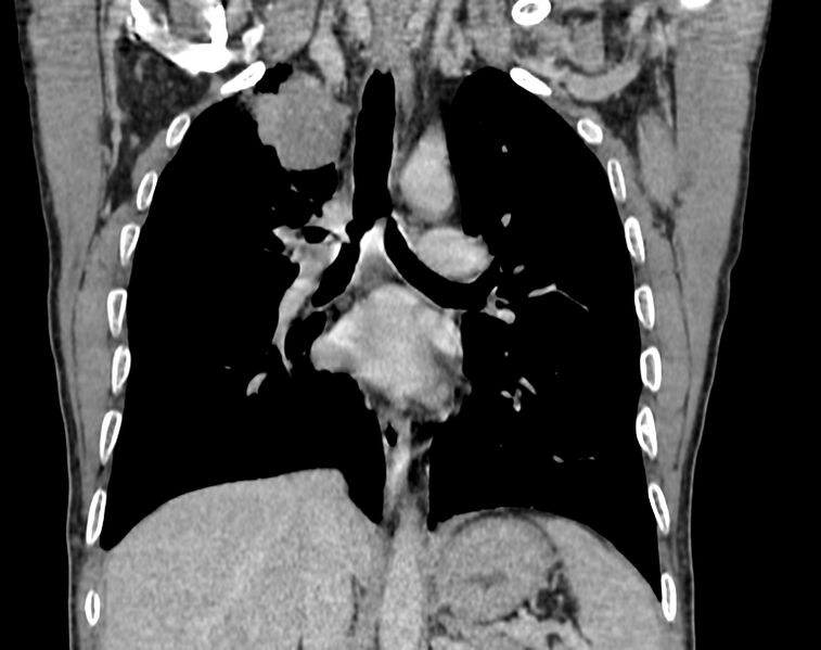 File:Bronchogenic carcinoma with superior vena cava syndrome (Radiopaedia 36497-38054 Coronal C+ delayed 51).jpg