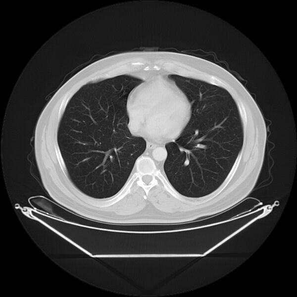 File:Bronchogenic carcinoma with upper lobe collapse (Radiopaedia 29297-29726 Axial lung window 22).jpg