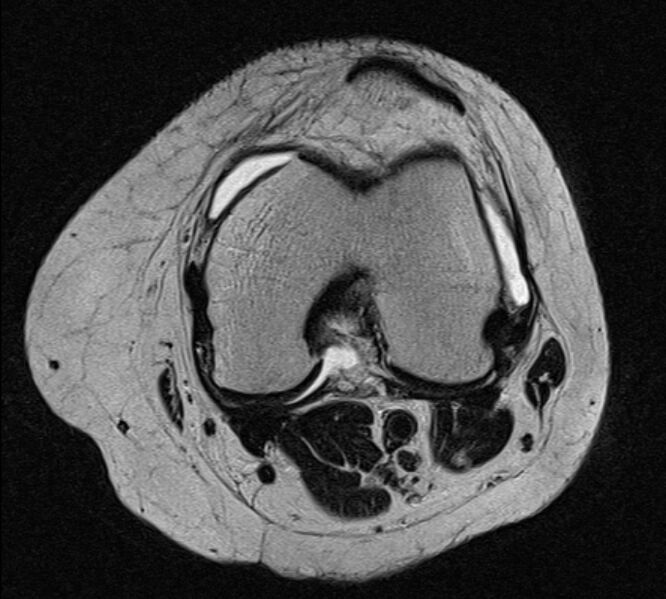 File:Bucket handle tear - medial meniscus (Radiopaedia 79028-91942 Axial T2 15).jpg