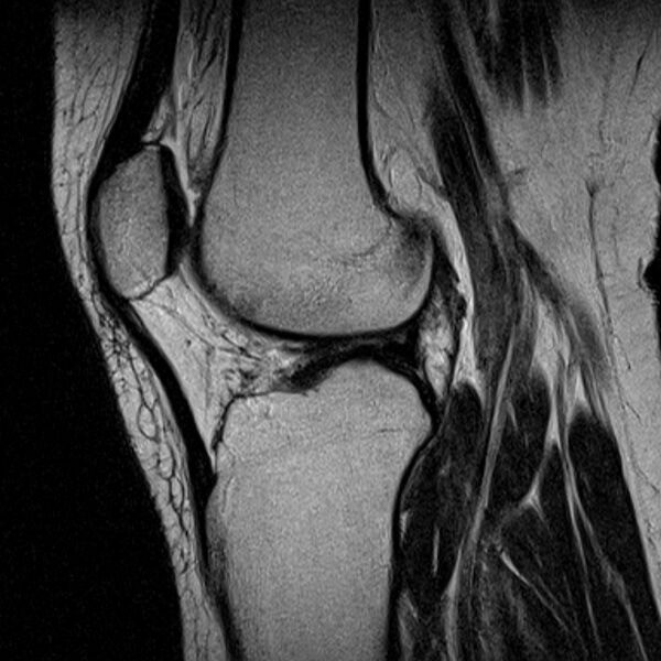File:Bucket handle tear - medial meniscus (Radiopaedia 79028-91942 Sagittal T2 10).jpg