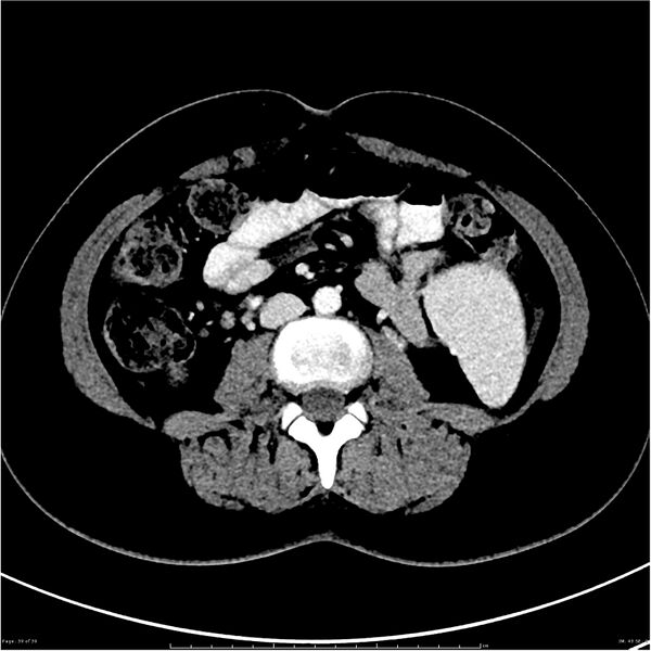 File:Budd-Chiari syndrome (Radiopaedia 27929-28177 Axial liver window 39).JPG