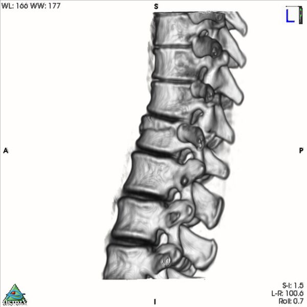File:Bulging of paraspinal line in traumatic thoracal spinal compression fracture (Radiopaedia 29221-35872 3D VR 24).jpg