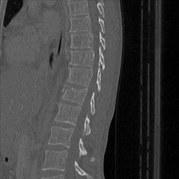 File:Bulging of paraspinal line in traumatic thoracal spinal compression fracture (Radiopaedia 29221-35872 Sagittal bone window 31).jpg