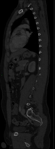 File:Burst fracture (Radiopaedia 83168-97542 Sagittal bone window 79).jpg