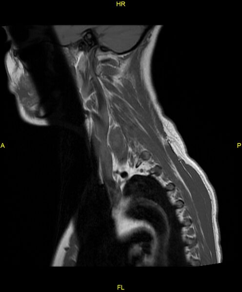 File:C5 nerve sheath tumor (Radiopaedia 85777-101596 Sagittal T1 17).jpg