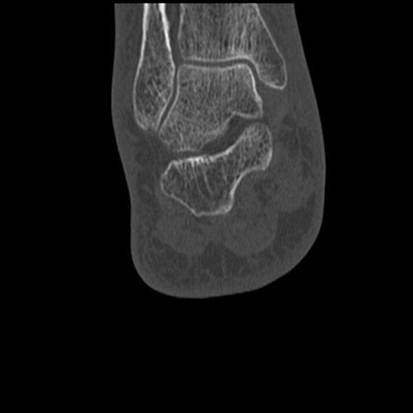 File:Calcaneal tuberosity avulsion fracture (Radiopaedia 22649-22668 Coronal bone window 51).jpg