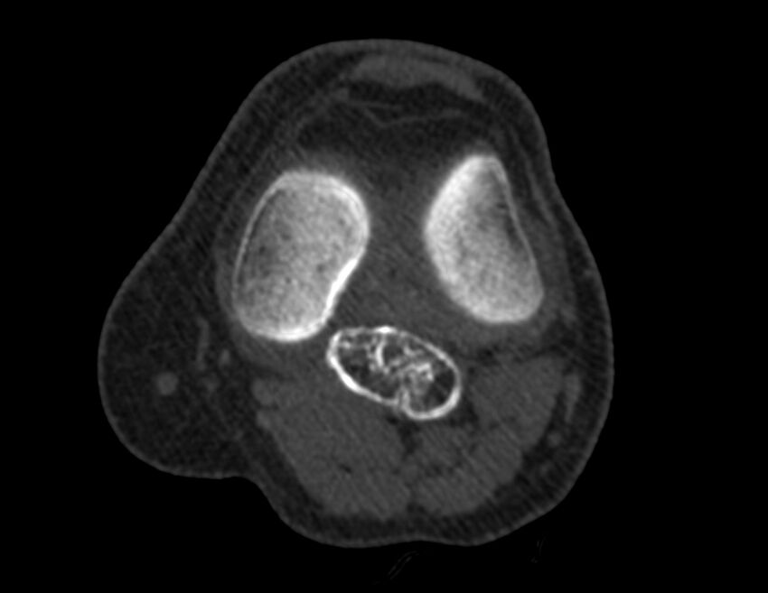 Calcified hematoma - popliteal fossa (Radiopaedia 63938-72763 Axial bone window 17).jpg