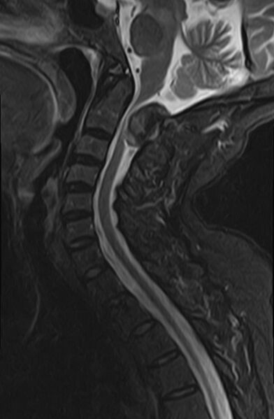 File:Calcified meningioma - cervical canal (Radiopaedia 70136-82468 Sagittal STIR 7).jpg