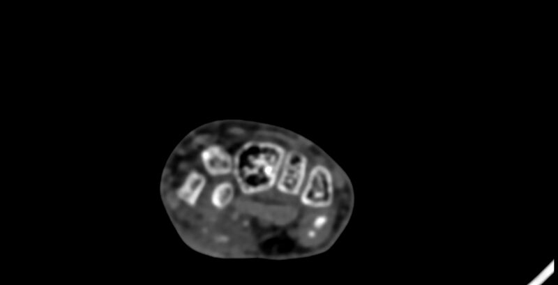 File:Calcifying aponeurotic fibroma (Radiopaedia 88423-105064 B 80).jpg
