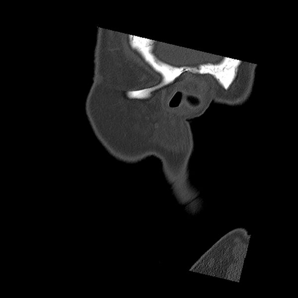 File:Canal up mastoidectomy (Radiopaedia 78108-90638 Sagittal bone window 5).jpg