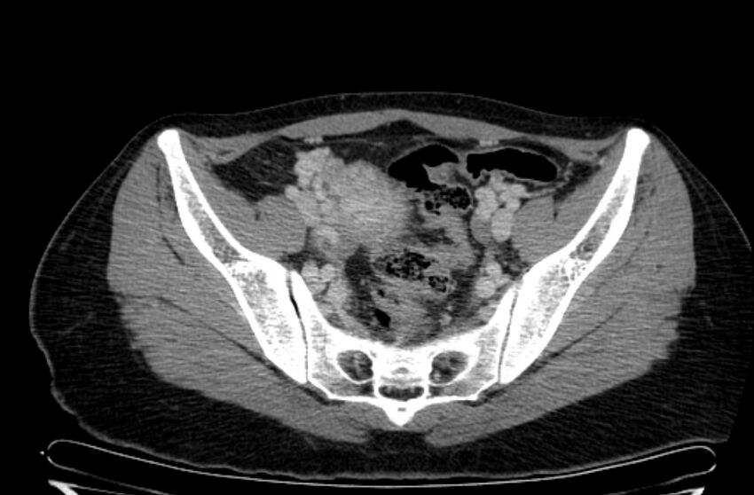 Cannonball metastases - uterine choriocarcinoma (Radiopaedia 70137-80174 A 13).jpg