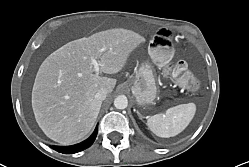 File:Carcinoid mesenteric tumor complicated by chylous ascites (Radiopaedia 76312-87953 A 14).jpg