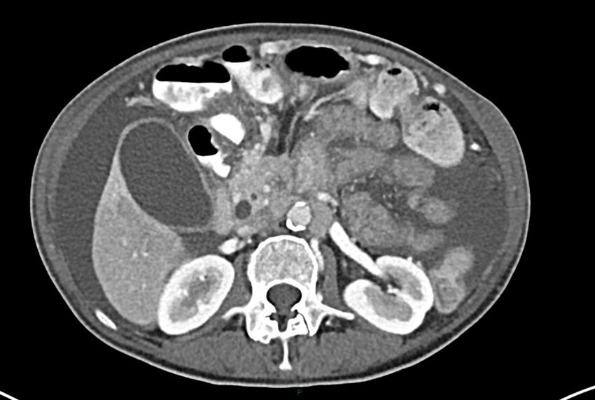 Carcinoid mesenteric tumor complicated by chylous ascites (Radiopaedia 76312-87953 A 28).jpg