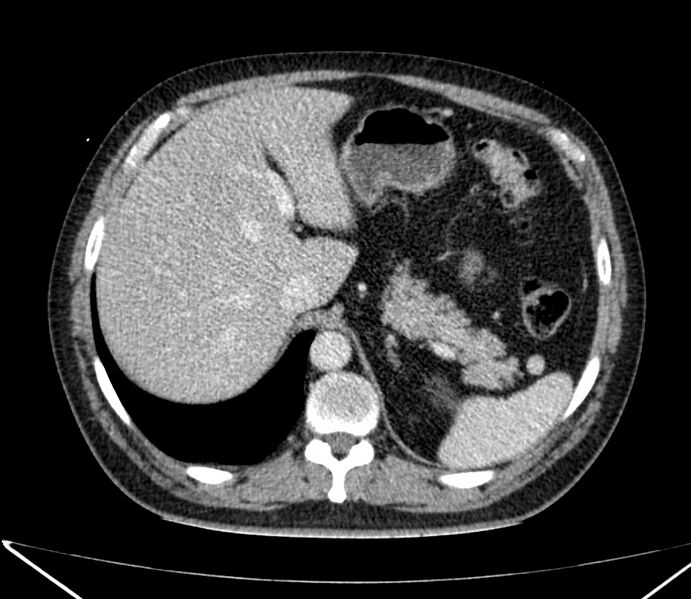 File:Carcinoid tumor with hepatic metastases (Radiopaedia 22651-22670 C 34).jpg