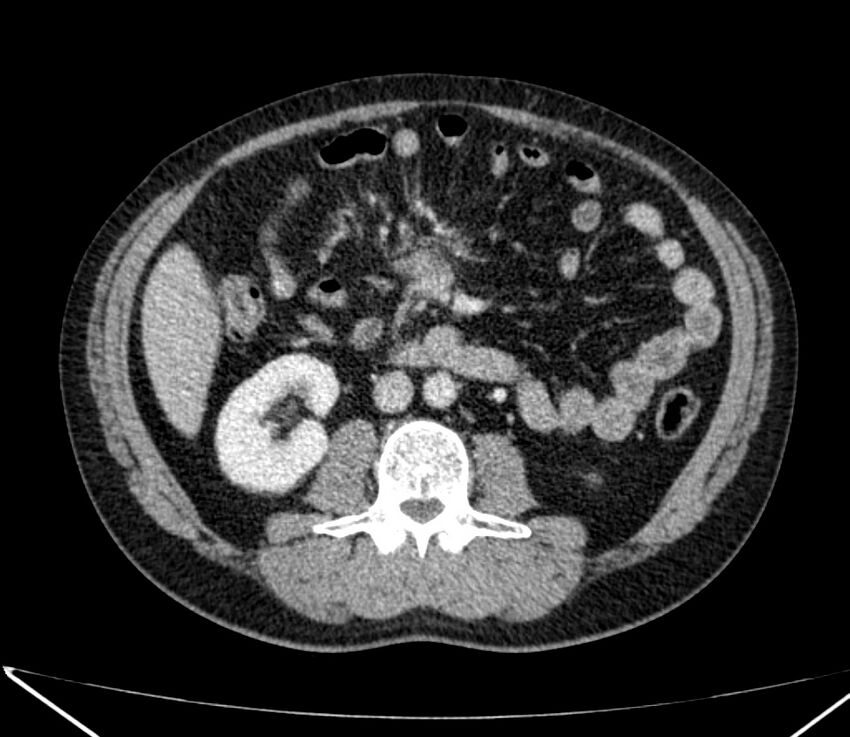 Carcinoid tumor with hepatic metastases (Radiopaedia 22651-22670 C 51).jpg