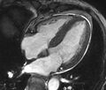 Cardiac amyloidosis (Radiopaedia 39736-42124 D 29).jpg