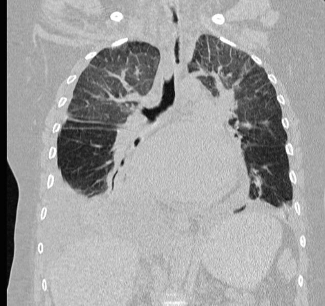 File:Cardiogenic pulmonary edema (Radiopaedia 29213-29609 Coronal lung window 36).jpg