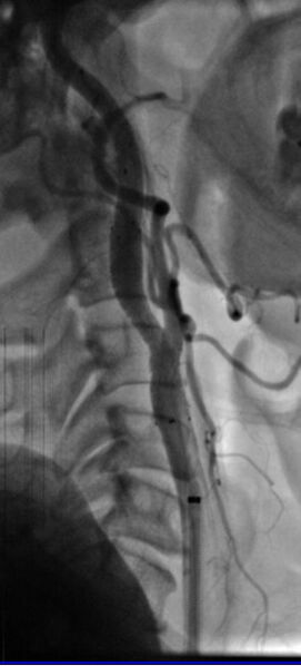 File:Carotid angioplasty (Radiopaedia 16766-16479 C 1).jpg