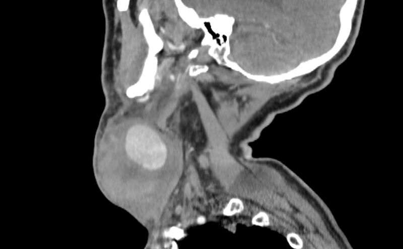 File:Carotid artery pseudoaneurysm (Radiopaedia 84030-99259 E 43).jpg
