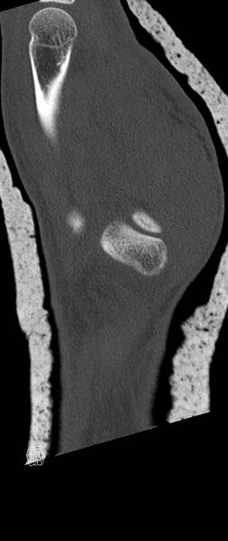 File:Carpal fractures (smart watch impaction) (Radiopaedia 55844-62430 Sagittal bone window 37).jpg