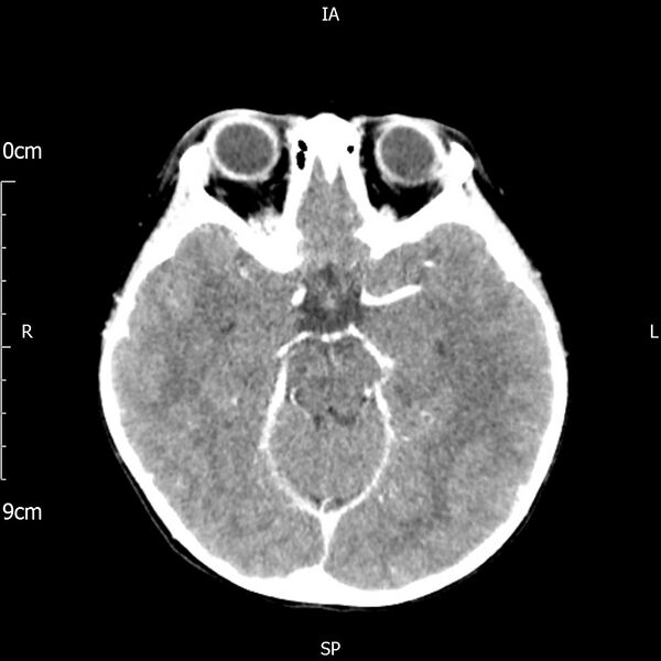 File:Cavernous sinus thrombosis (Radiopaedia 79414-92510 Axial Brain 87).jpg