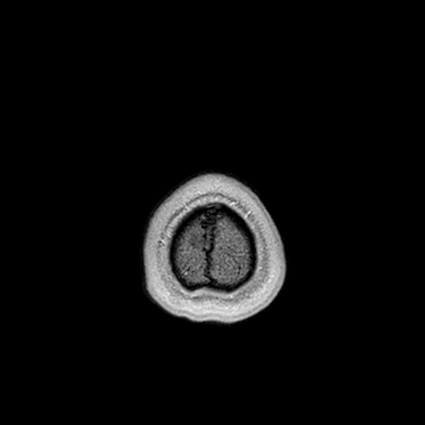 Central neurocytoma (Radiopaedia 79320-92380 Axial T1 C+ 228).jpg