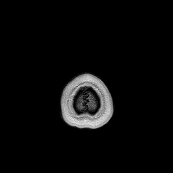 File:Central neurocytoma (Radiopaedia 79320-92380 Axial T1 C+ 231).jpg