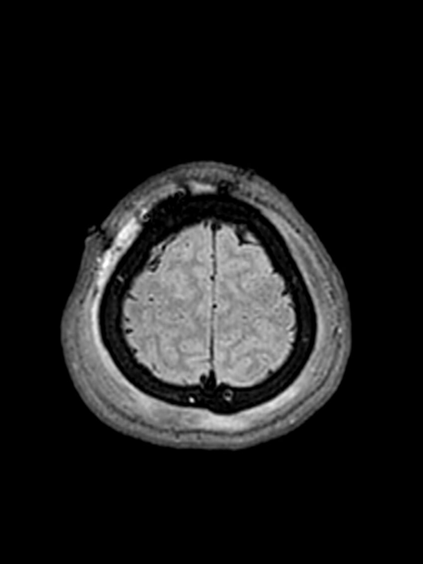 Central neurocytoma (Radiopaedia 79320-92381 Axial FLAIR 34).jpg