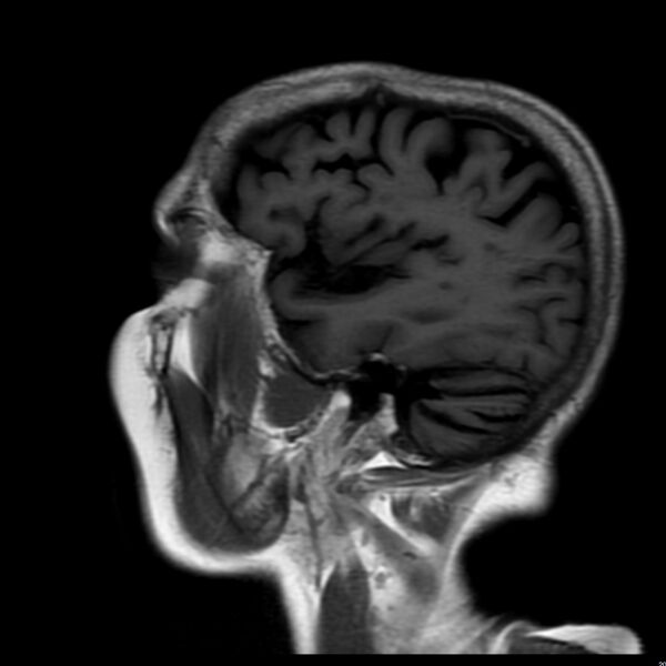 File:Cerebellar ataxia with neuropathy and vestibular areflexia syndrome (CANVAS) (Radiopaedia 74283-85159 Sagittal FLAIR 17).jpg