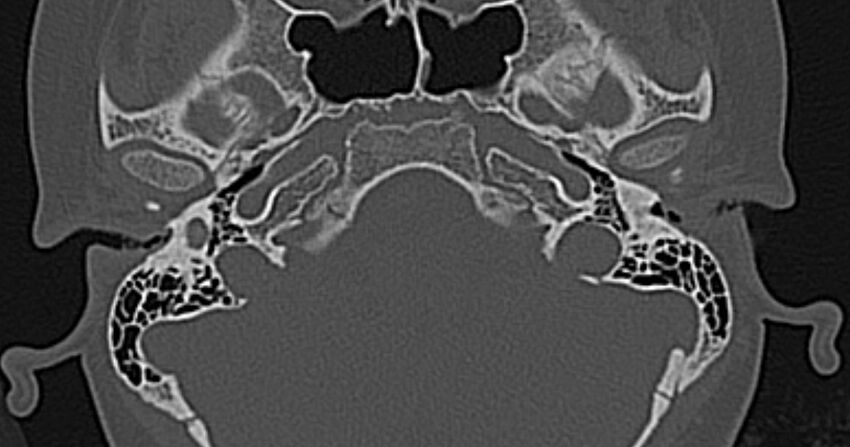 Cerebellopontine angle lipoma (Radiopaedia 57303-64242 Axial bone window 15).jpg