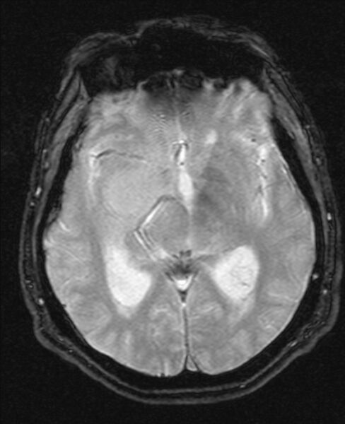 File:Cerebellopontine angle meningioma (Radiopaedia 24459-24764 Axial Gradient Echo 11).jpg