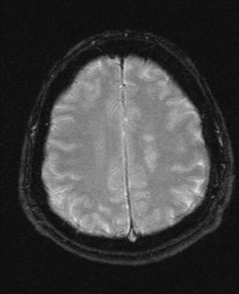 File:Cerebellopontine angle meningioma (Radiopaedia 24459-24764 Axial Gradient Echo 18).jpg