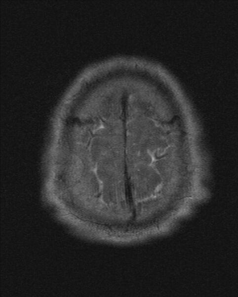 File:Cerebellopontine angle meningioma (Radiopaedia 24459-24764 Axial T2 22).jpg
