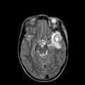 Cerebral abscess post cardiac surgery (Radiopaedia 27244-27420 Axial T2 10).jpg