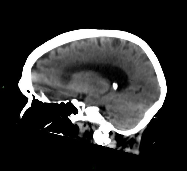 File:Cerebral amyloid angiopathy-associated lobar intracerebral hemorrhage (Radiopaedia 58377-65514 B 32).jpg