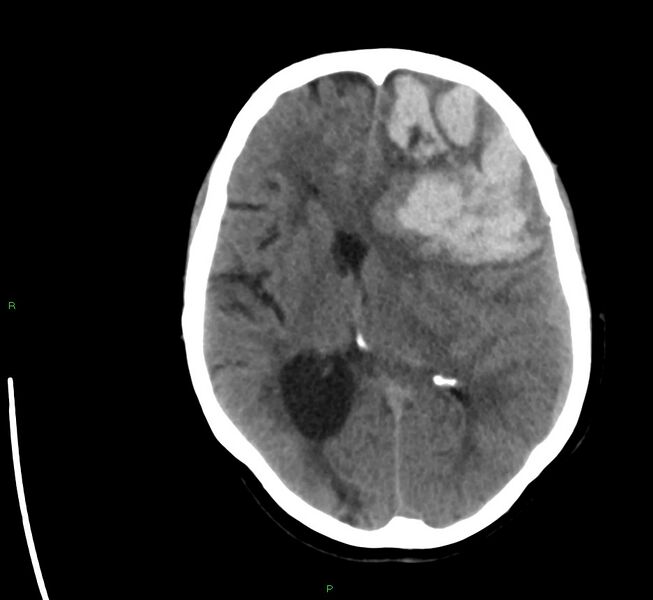 File:Cerebral amyloid angiopathy-associated lobar intracerebral hemorrhage (Radiopaedia 58561-65724 Axial non-contrast 23).jpg