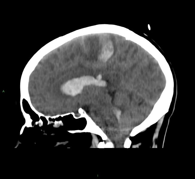 File:Cerebral amyloid angiopathy-associated lobar intracerebral hemorrhage (Radiopaedia 58566-65730 C 24).jpg