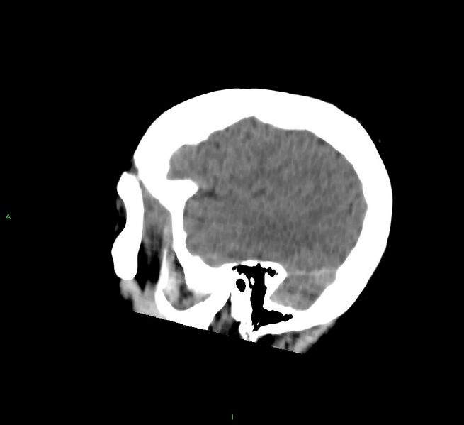 File:Cerebral amyloid angiopathy-associated lobar intracerebral hemorrhage (Radiopaedia 58756-65977 C 47).jpg