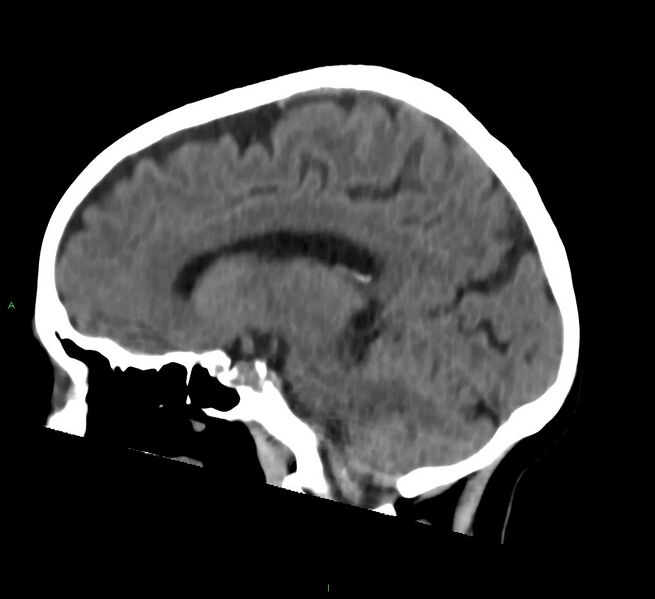 File:Cerebral amyloid angiopathy-associated lobar intracerebral hemorrhage (Radiopaedia 58757-65978 C 31).jpg
