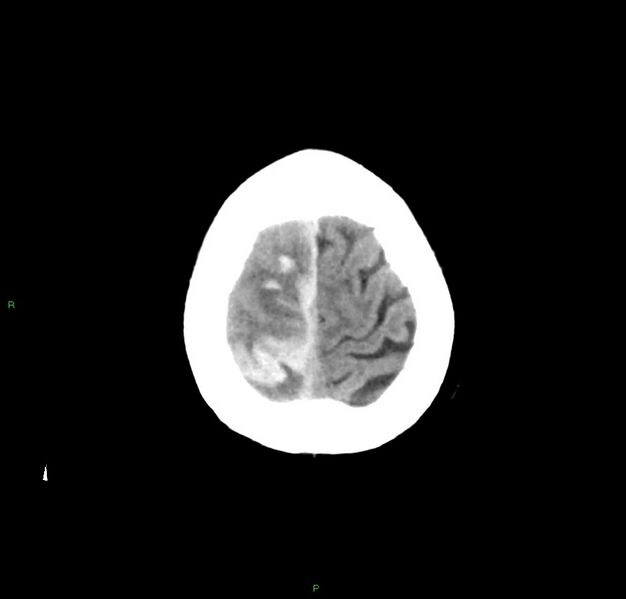 File:Cerebral amyloid angiopathy-associated lobar intracerebral hemorrhage (Radiopaedia 59356-66716 Axial non-contrast 6).jpg