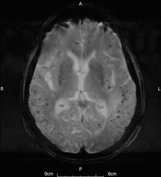 File:Cerebral amyloid angiopathy related inflammation (Radiopaedia 72772-83415 Axial SWI 12).jpg