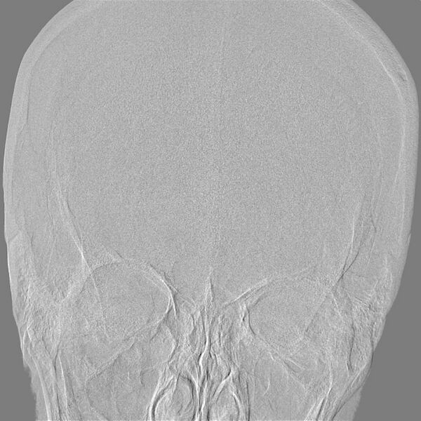 File:Cerebral aneurysm with rupture (Radiopaedia 29933-30458 LT ICA IC 1).jpg