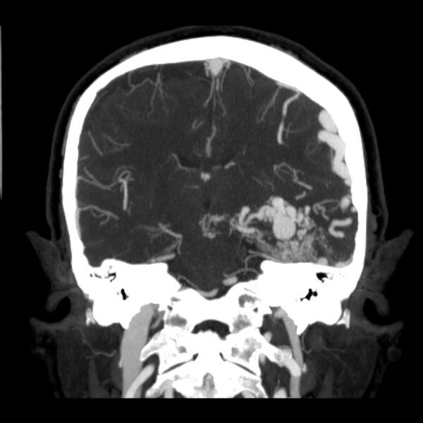File:Cerebral arteriovenous malformation (Radiopaedia 43729-47189 C 26).jpg