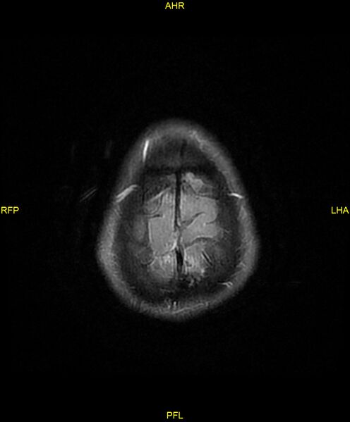 File:Cerebral autosomal dominant arteriopathy with subcortical infarcts and leukoencephalopathy (CADASIL) (Radiopaedia 86108-102054 Axial FLAIR 28).jpg