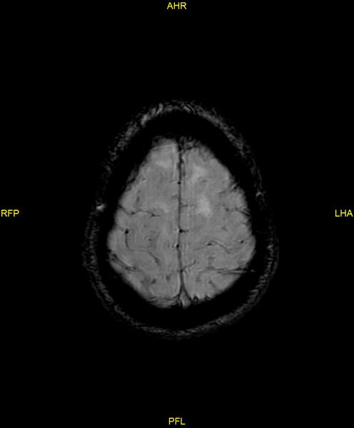 File:Cerebral autosomal dominant arteriopathy with subcortical infarcts and leukoencephalopathy (CADASIL) (Radiopaedia 86108-102054 Axial SWI 93).jpg