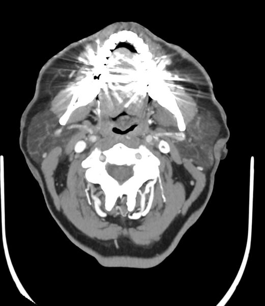 File:Cerebral dural venous sinus thrombosis (Radiopaedia 86514-102576 A 9).jpg