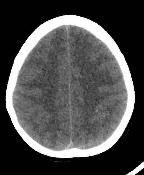 File:Cerebral edema due to severe hyponatremia (Radiopaedia 89826-106937 Axial non-contrast 67).jpg