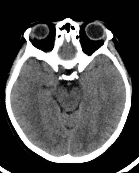 File:Cerebral edema due to severe hyponatremia (Radiopaedia 89826-106938 Axial non-contrast 42).jpg