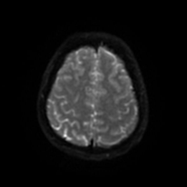 File:Cerebral fat embolism (Radiopaedia 37510-39363 Axial DWI 44).jpg