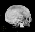 Cerebral hemorrhagic contusions (Radiopaedia 23145-23188 3D MIP 6).jpg